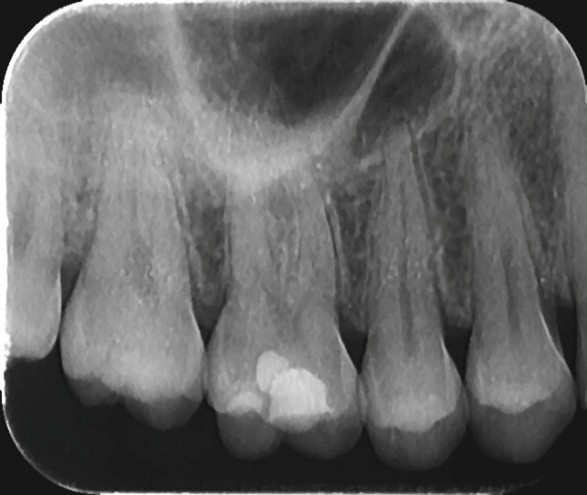 Retroalveolarni snimak